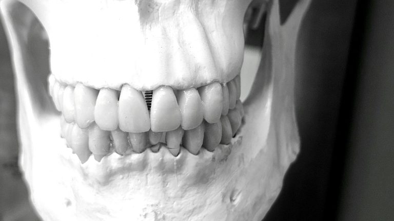 Detailed image of a human skull showcasing dental structure and alignment in a medical context.