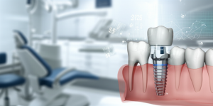 Additional Illustration of Costuri reale implanturi fără os 2026: analiza prețurilor